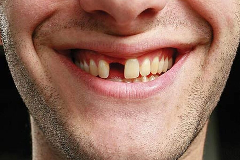 Why Is It Best To Replace A Missing Tooth?